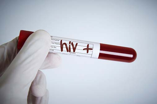 Laboratory Hiv Test, Hiv Positive